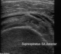 Shoulder Ultrasound Supraspinatous Tear